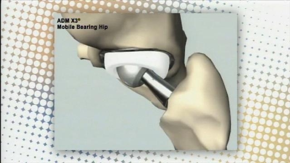 The Latest Hip Replacement Technology KATU